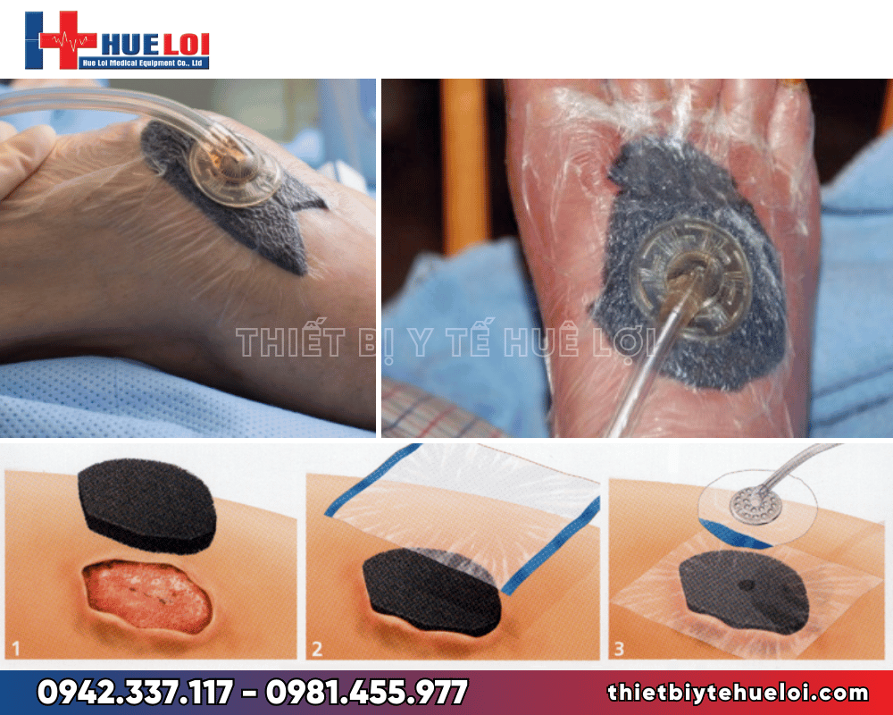 Máy hút áp lực âm điều trị vết thương giá rẻ